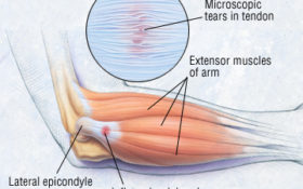 Carolina Sports & Ortho - Carolina Brace